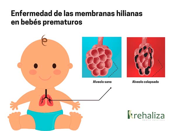 Enfermedad membranas hilianas bebe prematuro