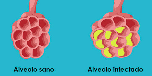 Alveolo sano y afectado