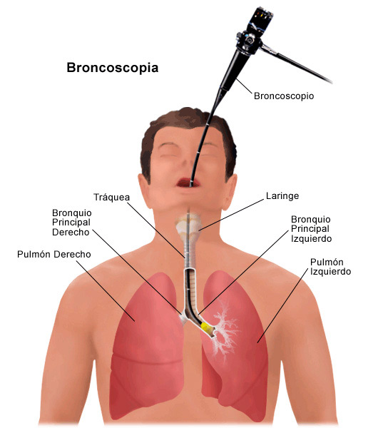 Cómo se realiza una broncoscopia
